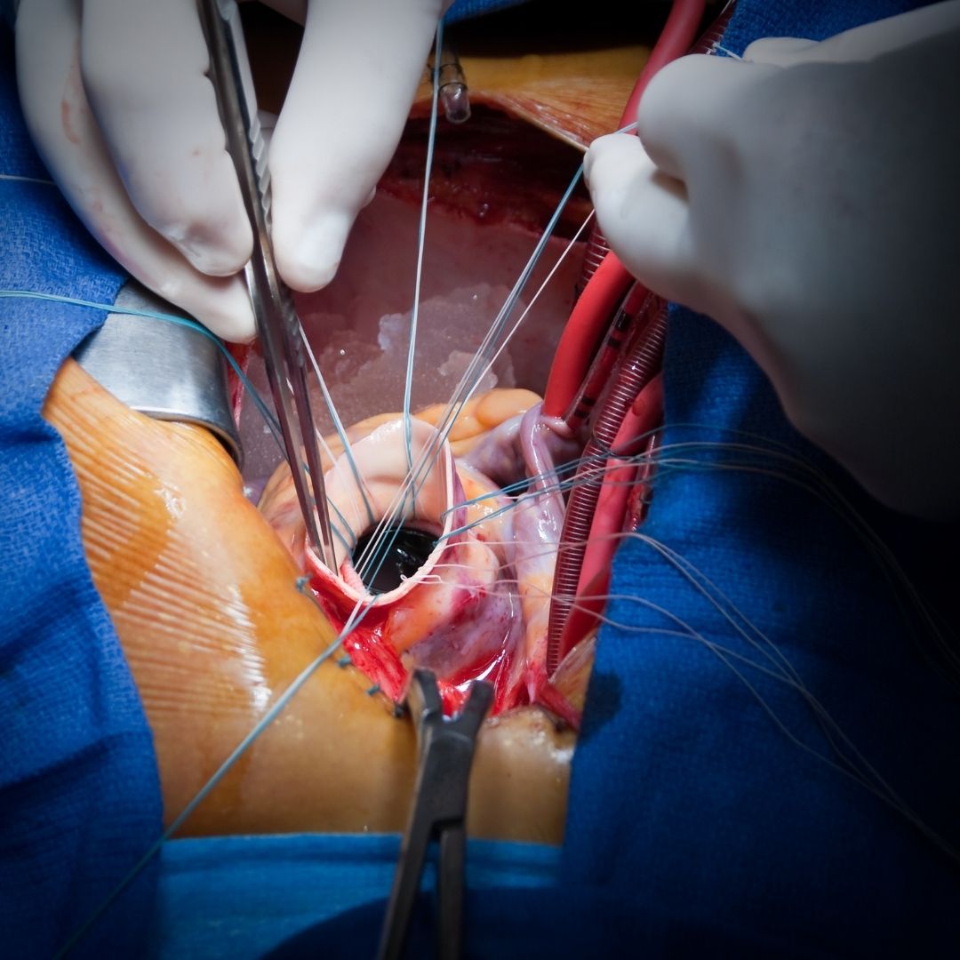 Kalp Kapak Ameliyatları ve Tedavisi